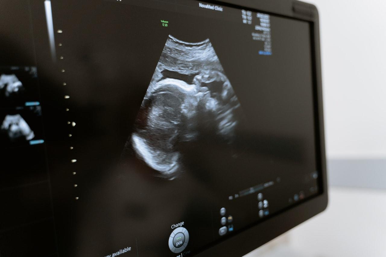 Ultrasound of fetus