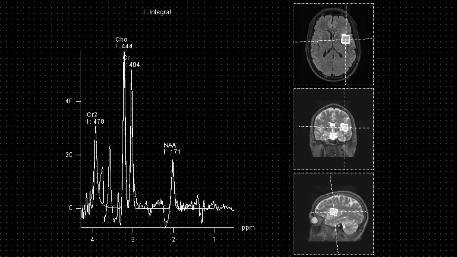 MRI scan of a high-grade glioma in a patient’s brain with graph readings that show the abnormal metabolites in the glioma.