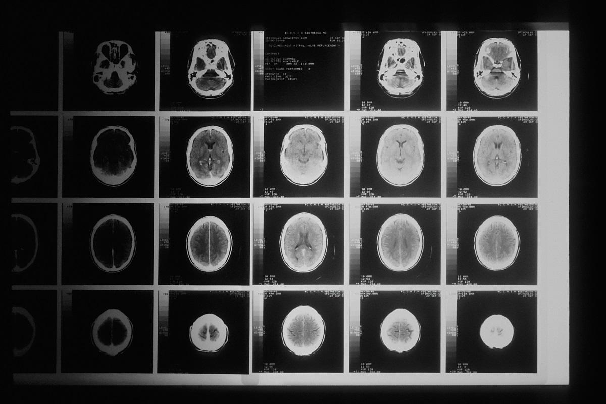 MRI of many brains