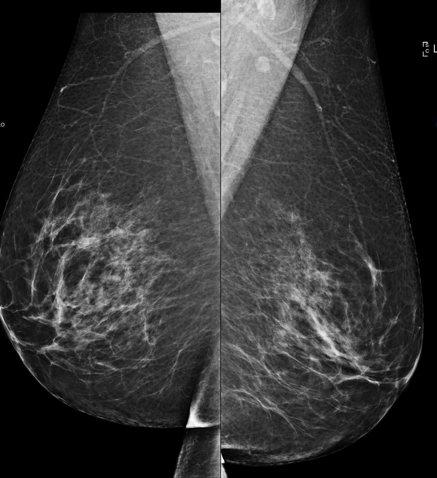 Mammogram