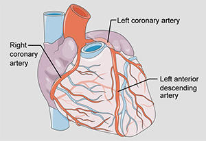 Illustration of the human heart featuring the coronary arteries, including the left anterior descending artery whose blockage causes the widow maker heart attack.